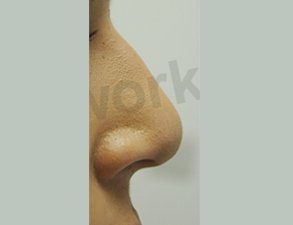 Nose Fillers After