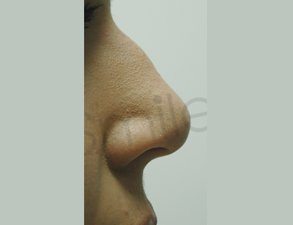 Nose Fillers Liverpool Before