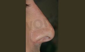 Non surgical nose job after