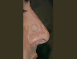 Non surgical nose job after