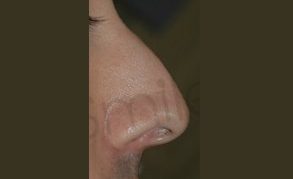 Non surgical nose job liverpool before