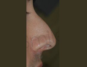 Non surgical nose job liverpool before