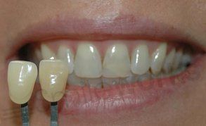 tooth bleaching before