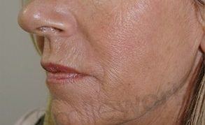 Nose to mouth lines after 4