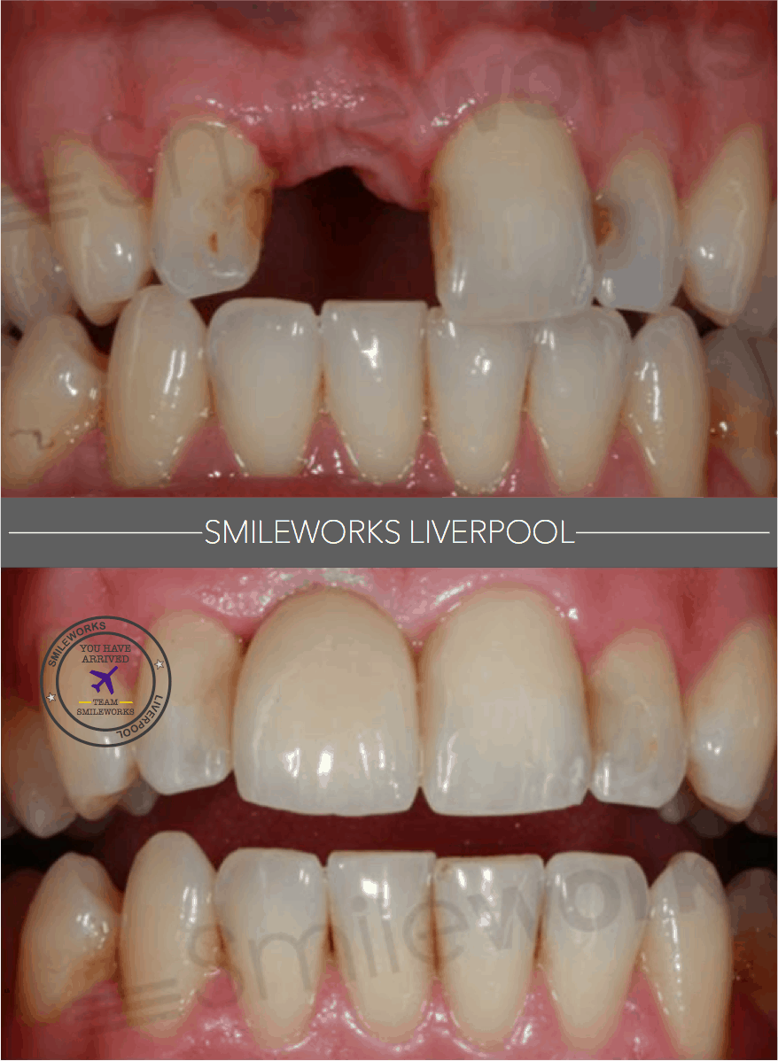 Dental Implants Liverpool £94/m cost Replace missing teeth in 2019