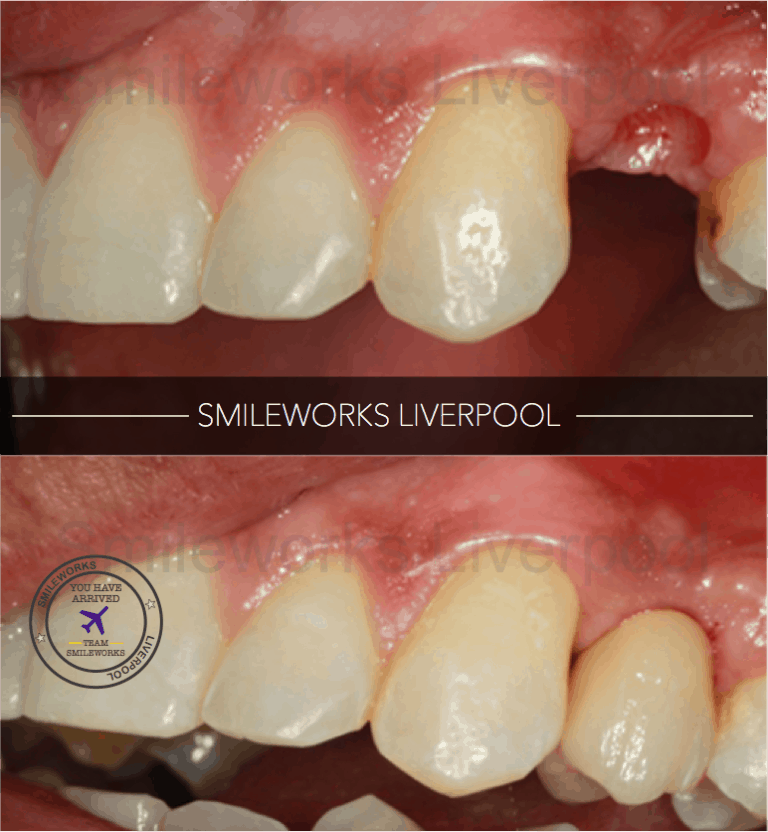 Dental Implants Liverpool £94/m cost Replace missing teeth in 2020