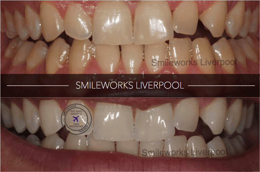 Teeth Whitening Liverpool Beautiful, Bright and Responsible