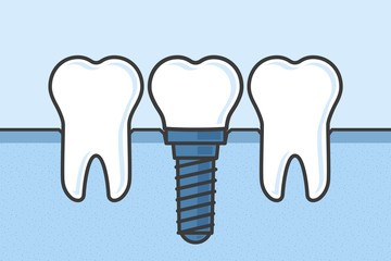 Are dental implants safe?