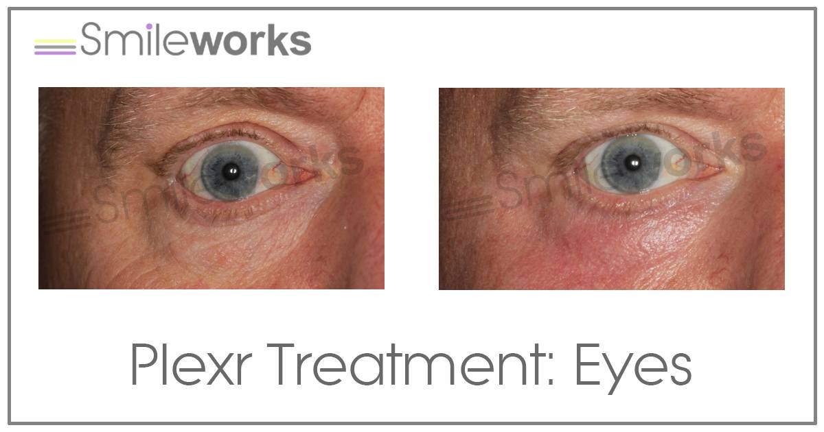 plexr non surgical blepharoplasty