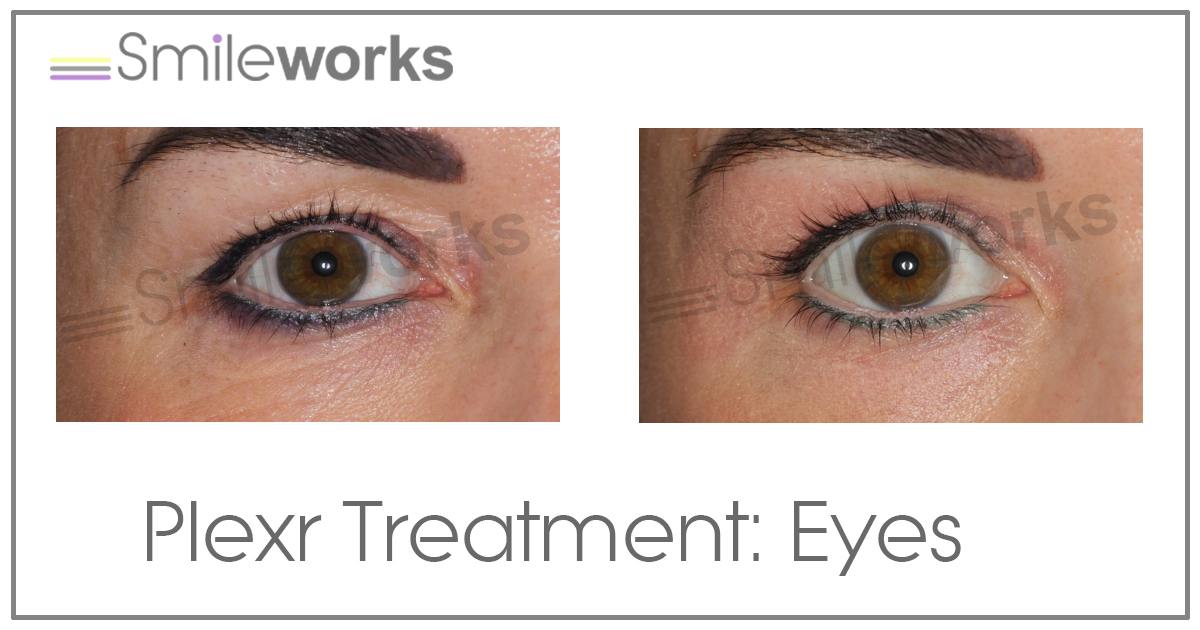Plexr eye lift deals