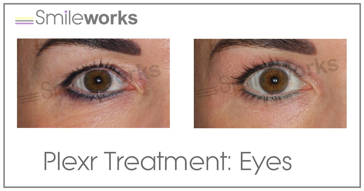 Permanent eye lift results