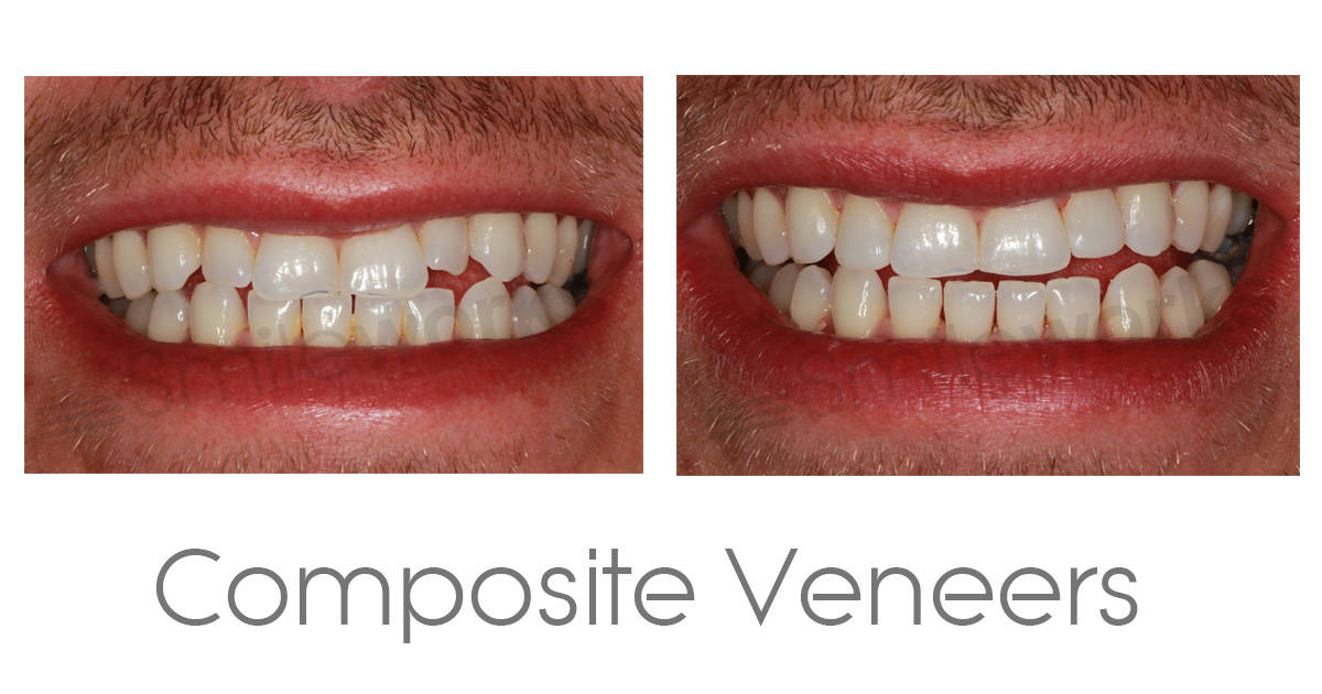 Composite Veneers We compare safety, durability, aesthetic and price