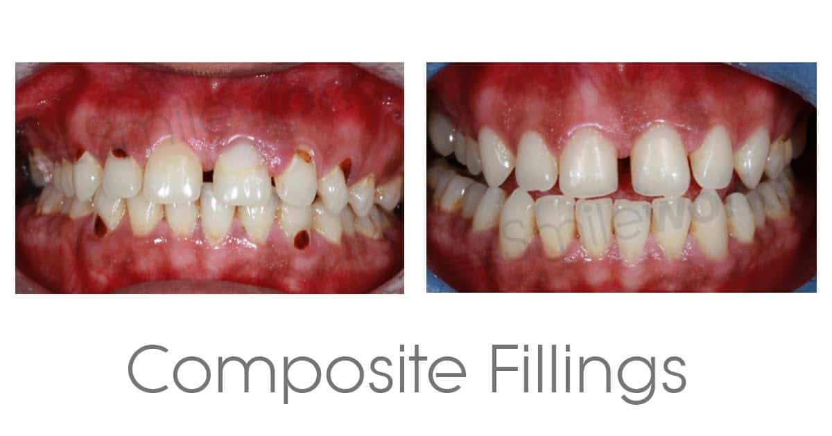 Composite Veneers We compare safety, durability, aesthetic and price