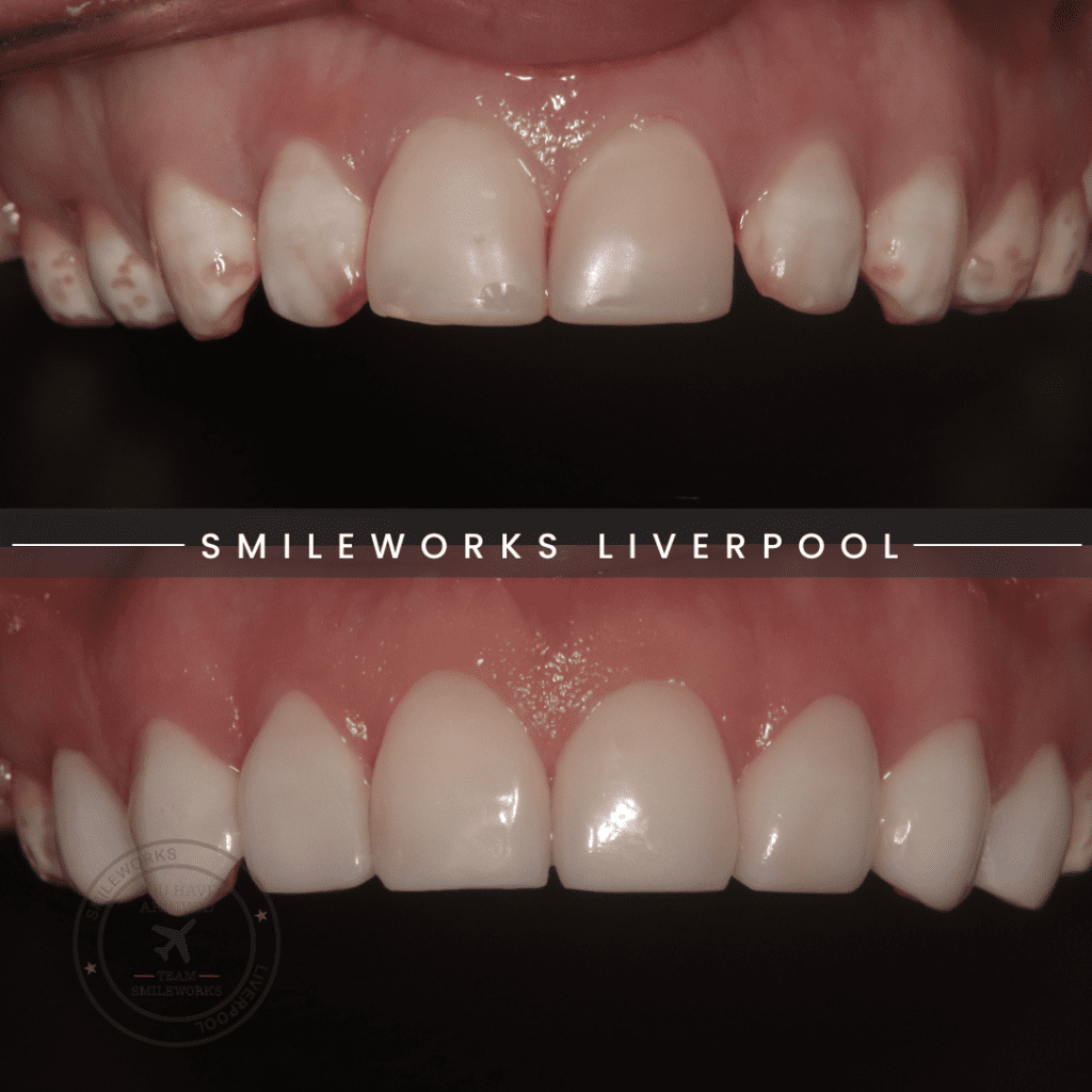 Composite Veneers Unbiased professional review for 2024