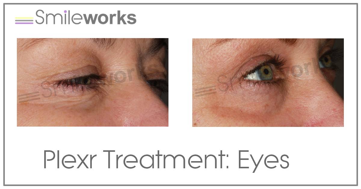 plexr non surgical upper eyelid surgery