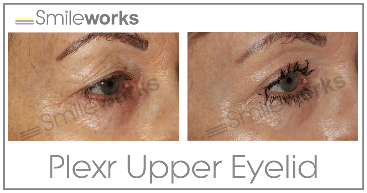 Plexr eye lift deals