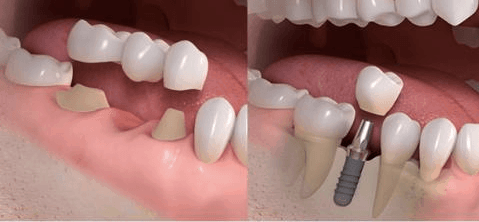 Difference between bridge and implant