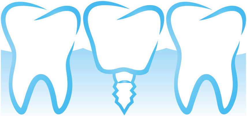 dental bridge vs implant