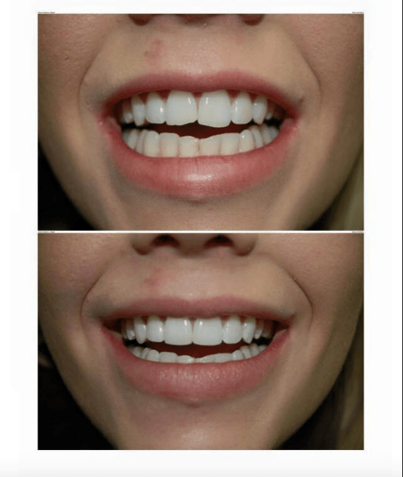 composite veneer before and after