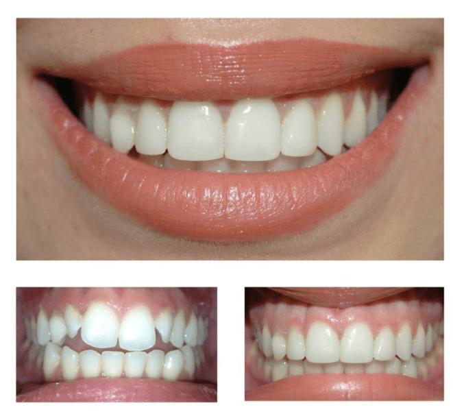composite veneer before and after