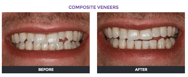 resin bonding before and after