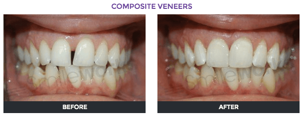 tooth bonding gallery