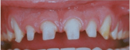 Preparing the teeth by drilling