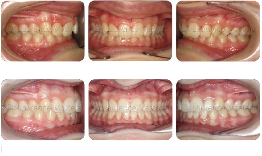 Remarkable Braces Liverpool £48.56p/m *Free Whitening*