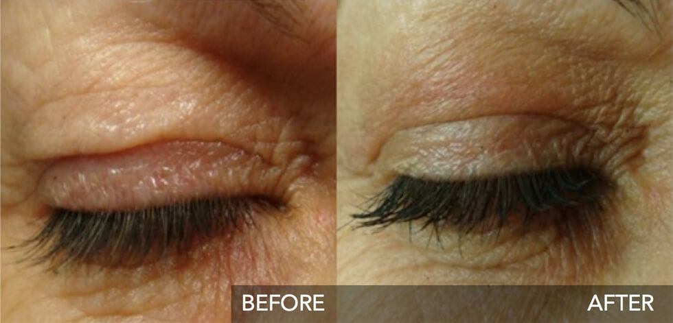 Plexr non surgical eye lift before and after