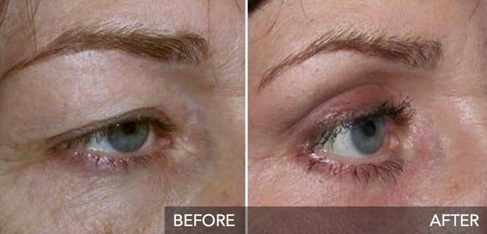 plexr non surgical eye lift before and after