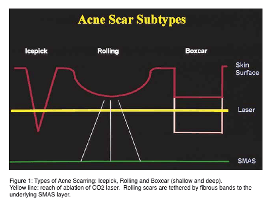 Acne scar subtypes