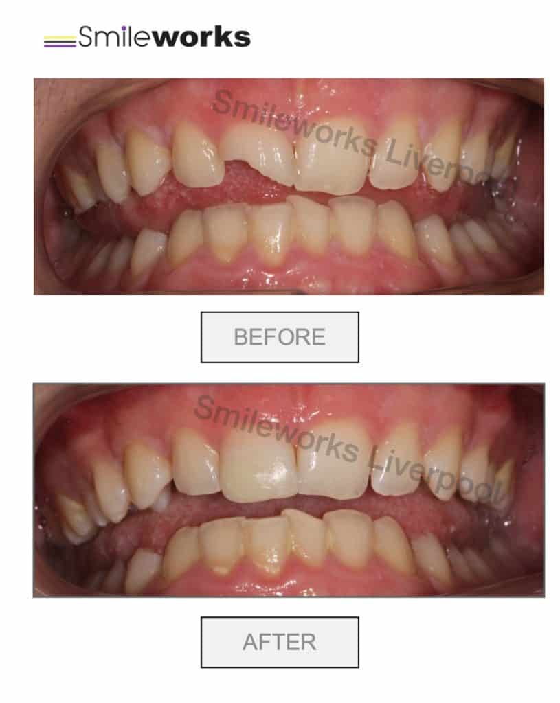 Broken tooth fixed with resin to restore enamel