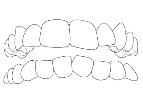 overcrowded teeth