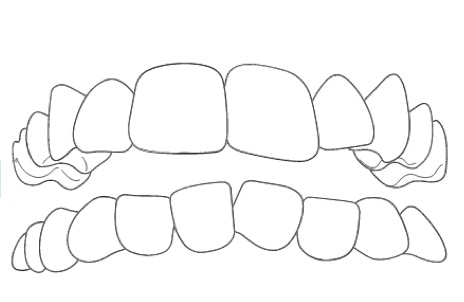 crowded teeth