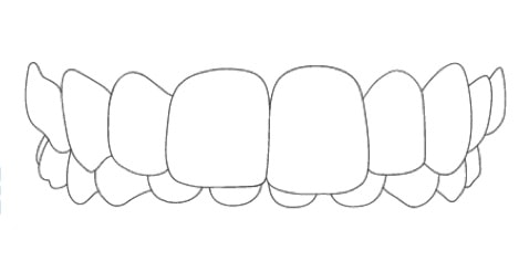 overbite braces