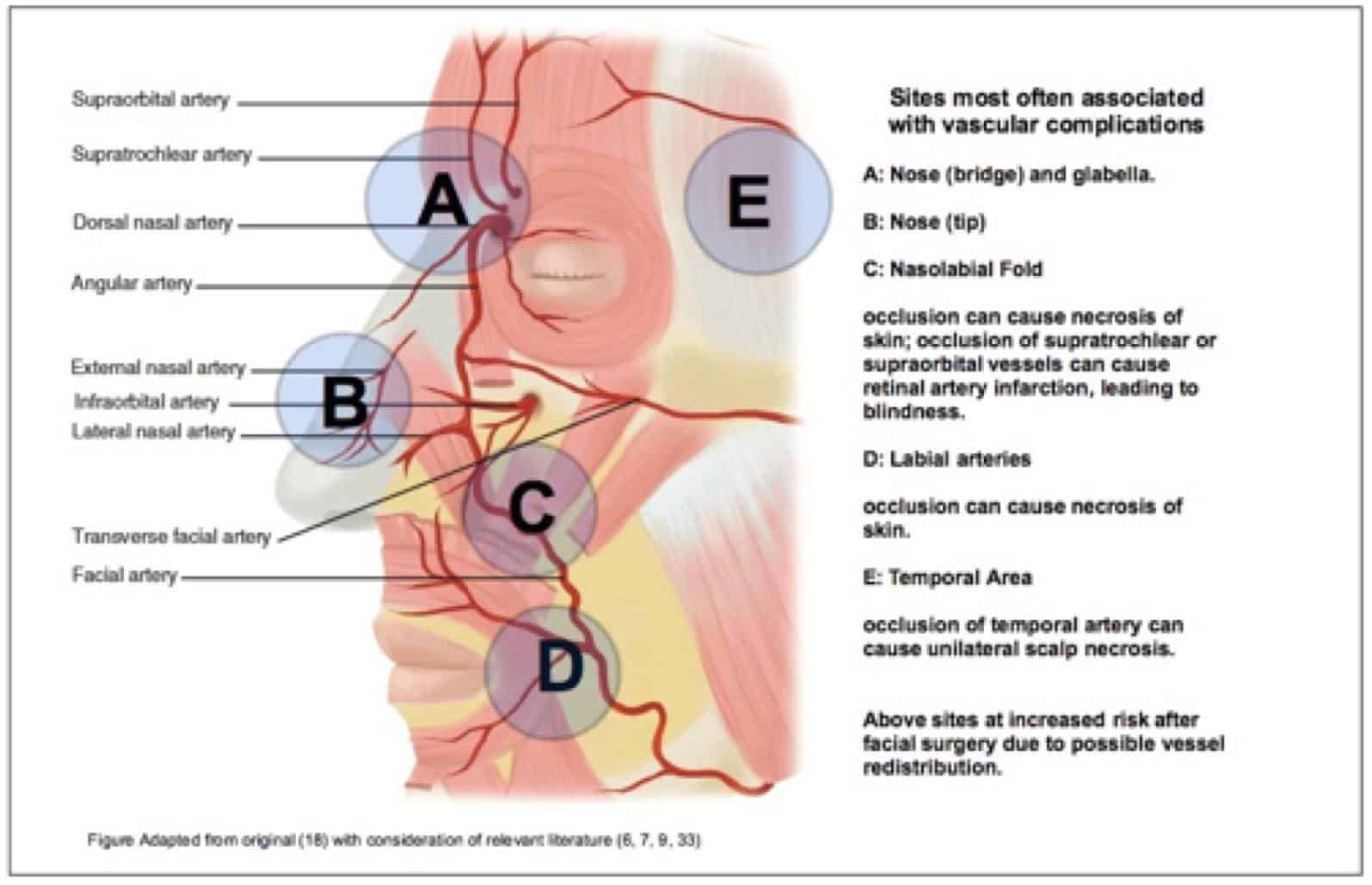 Figure 3- High risk areas of the face