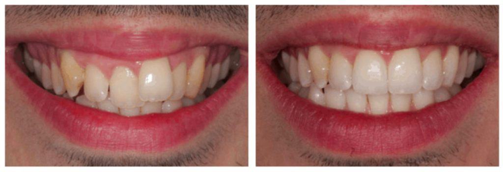 Inman Aligner before and after
