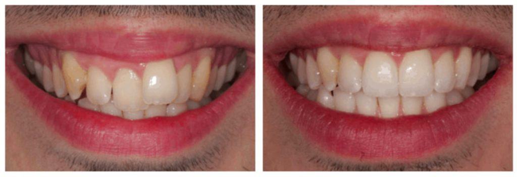 Inman Aligner Liverpool The Remarkable 16 Week Removable Braces