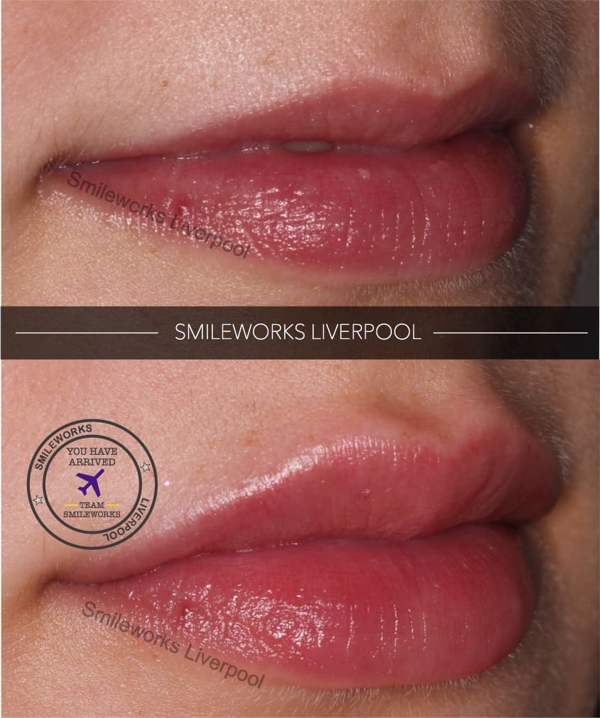Lip Fillers Liverpool Full Plump And Natural Lips From Just £170