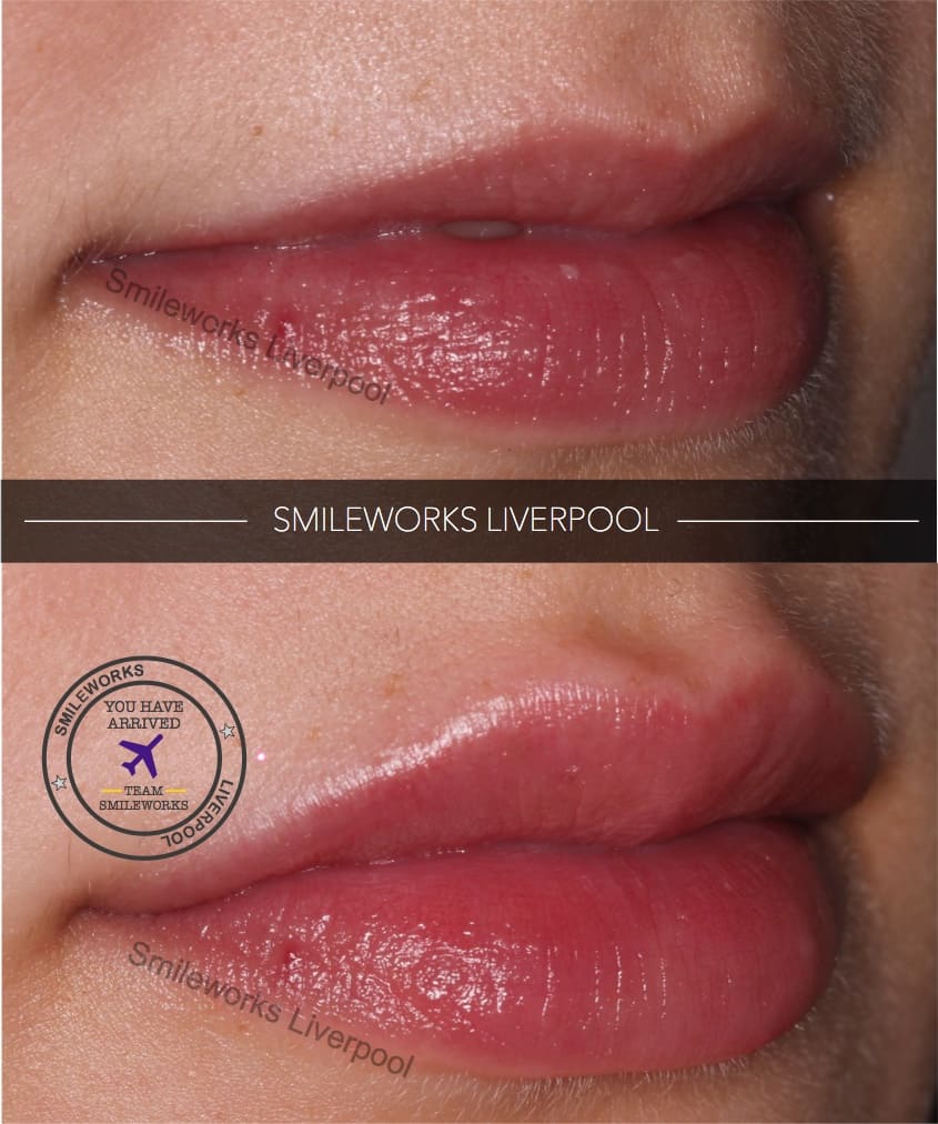 Lip Fillers Liverpool Full, Plump and Natural Lips from just £170