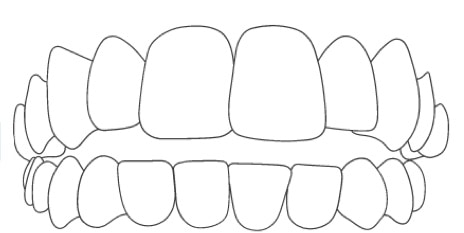 braces for crossbte