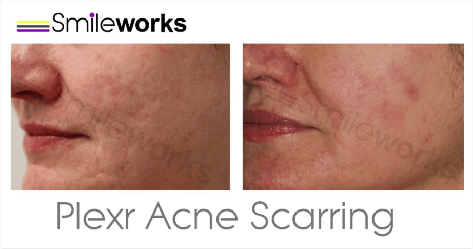 Acne scar removal with plexr