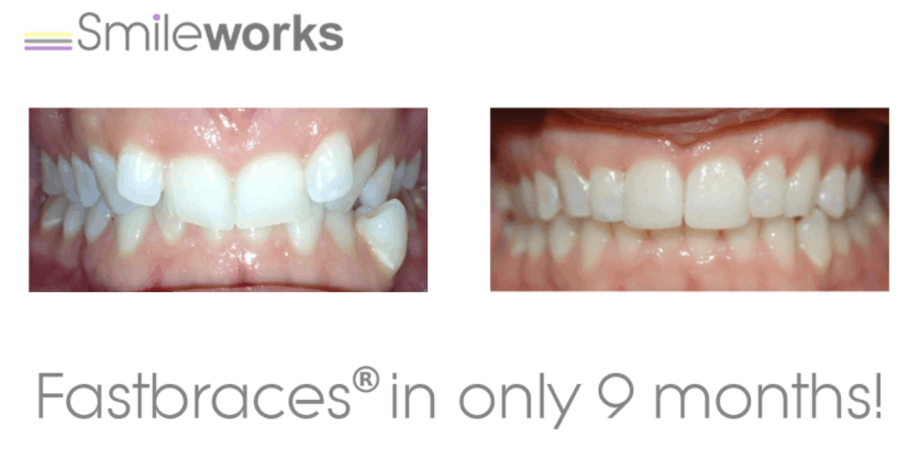 braces before and after