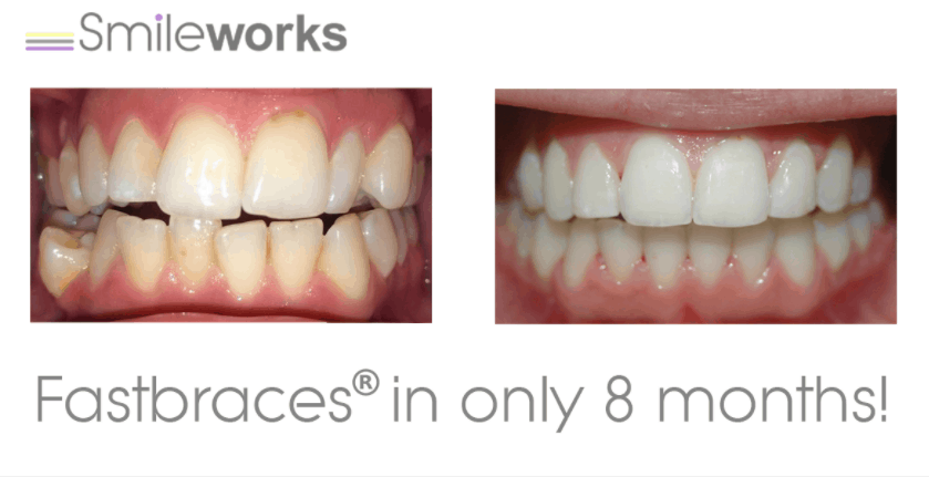 fastbraces liverpool before and after