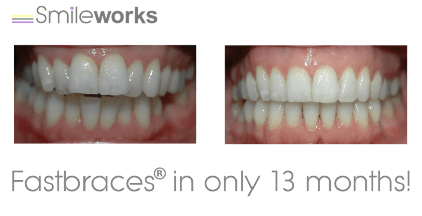 fastbraces before and after