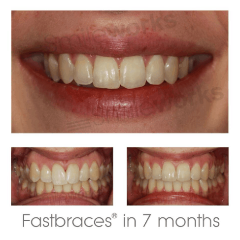 fastbraces braces before and after