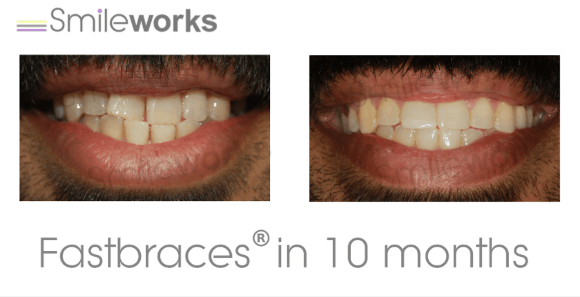 braces before and after