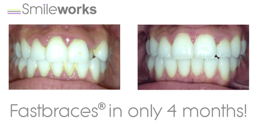 braces before and after