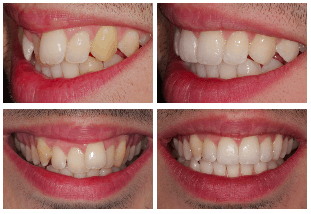 Inman Aligner before and after