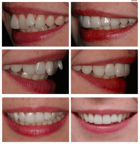 Inman Aligner Liverpool The Remarkable 16 Week Removable Braces